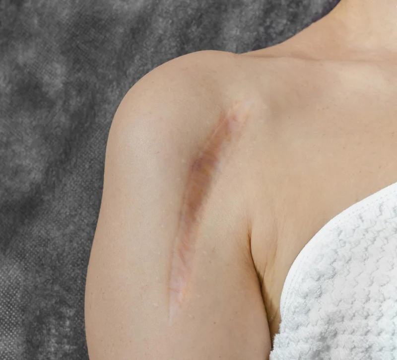 Fisioterapia en cicatrices Valeria de Gatica